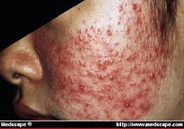 art wh3076.fig4 5 Easy Tips For Treating Acne