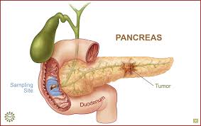 Pancreatic Cancer