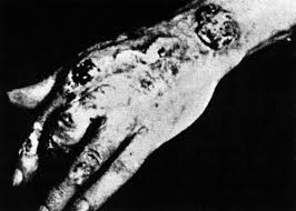 radiation exposure over 15