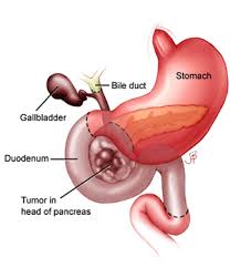 Pancreatic Cancer