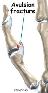 Avulsion Fracture picture