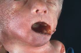 An infant with trisomy 18