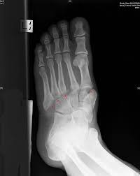 Lisfranc injury