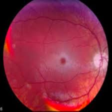 Tay-Sachs disease images