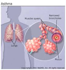Asthma: Symptoms, Allergens and Treatment