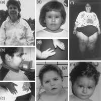 Prader Willi Syndrome Complete