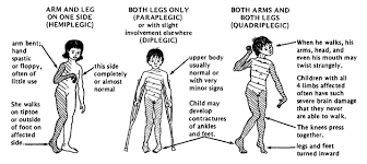 Cerebral Palsy Movement