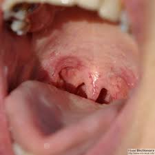 pictures cavity