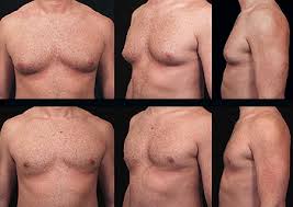 gynecomastia