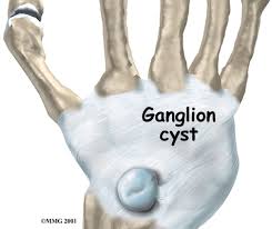 ganglions