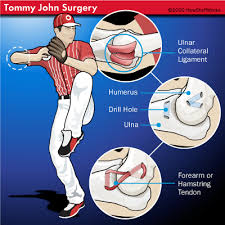 Tommy John Surgery
