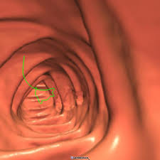 Virtual Colonoscopy