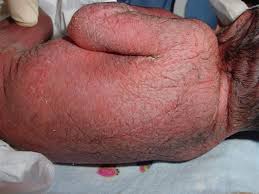 Sepsis is a severe illness in