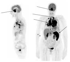 tissue is lymphoma and the