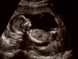 ultrasound at 16 weeks