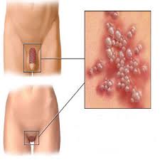 health consequences of HPV