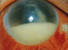 endophthalmitis should be