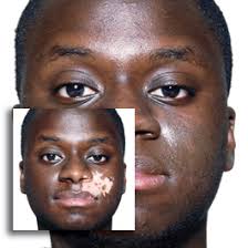 Cover FX Vitiligo Coverage