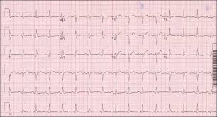 You acquire a 12-lead EKG.