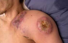 Non-Hodgkins lymphoma is the