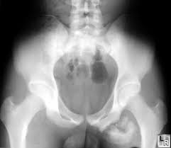 Healing avulsion fracture of