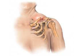 Distal Third Clavicle Fracture