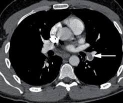 mans pulmonary embolism