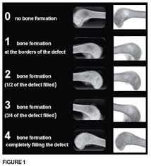 bone formation