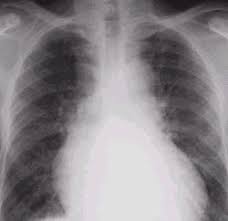 and pulmonary congestion