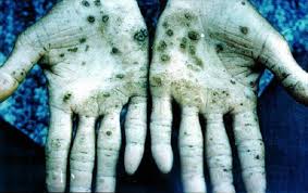 Arsenic-induced hyperkeratosis