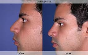 rhinoplasty