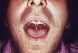 Gonorrhea