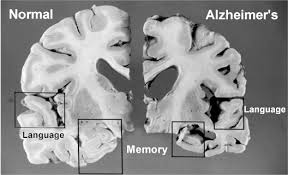 Palliative Care for Dementia