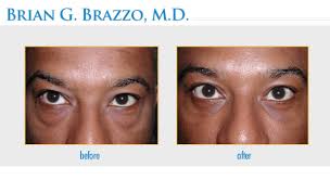 eyelid droop