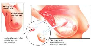 lumpectomy is most often
