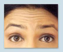 forehead wrinkles