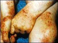 link to blood cancer risk