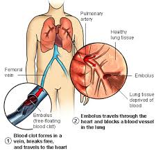 and pulmonary embolism.