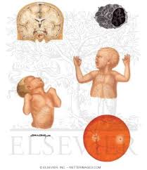 Tay-Sachs Disease: Signs and