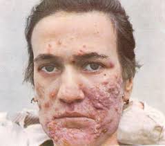 http://t3.gstatic.com/images?q=tbn:kuTnSPnMNJm5-M:luskiewnik.strefa.pl/akne/user/image/acne_vulgaris400.jpg