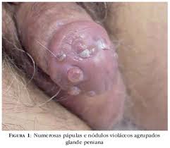 adenopatia inguinal