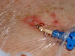 Line sepsis