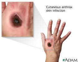Cutaneous anthrax