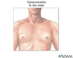 gynecomastia
