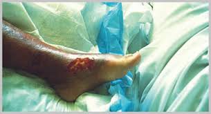 Septicemia and death occurring