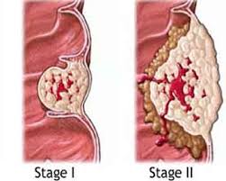 2011 | Cancer Symptoms
