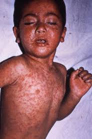 U.S. Measles