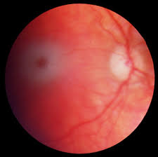 Tay-Sachs Disease - G(M2)