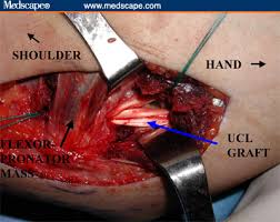 tommy john surgery
