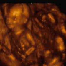 ultrasound at 16 weeks